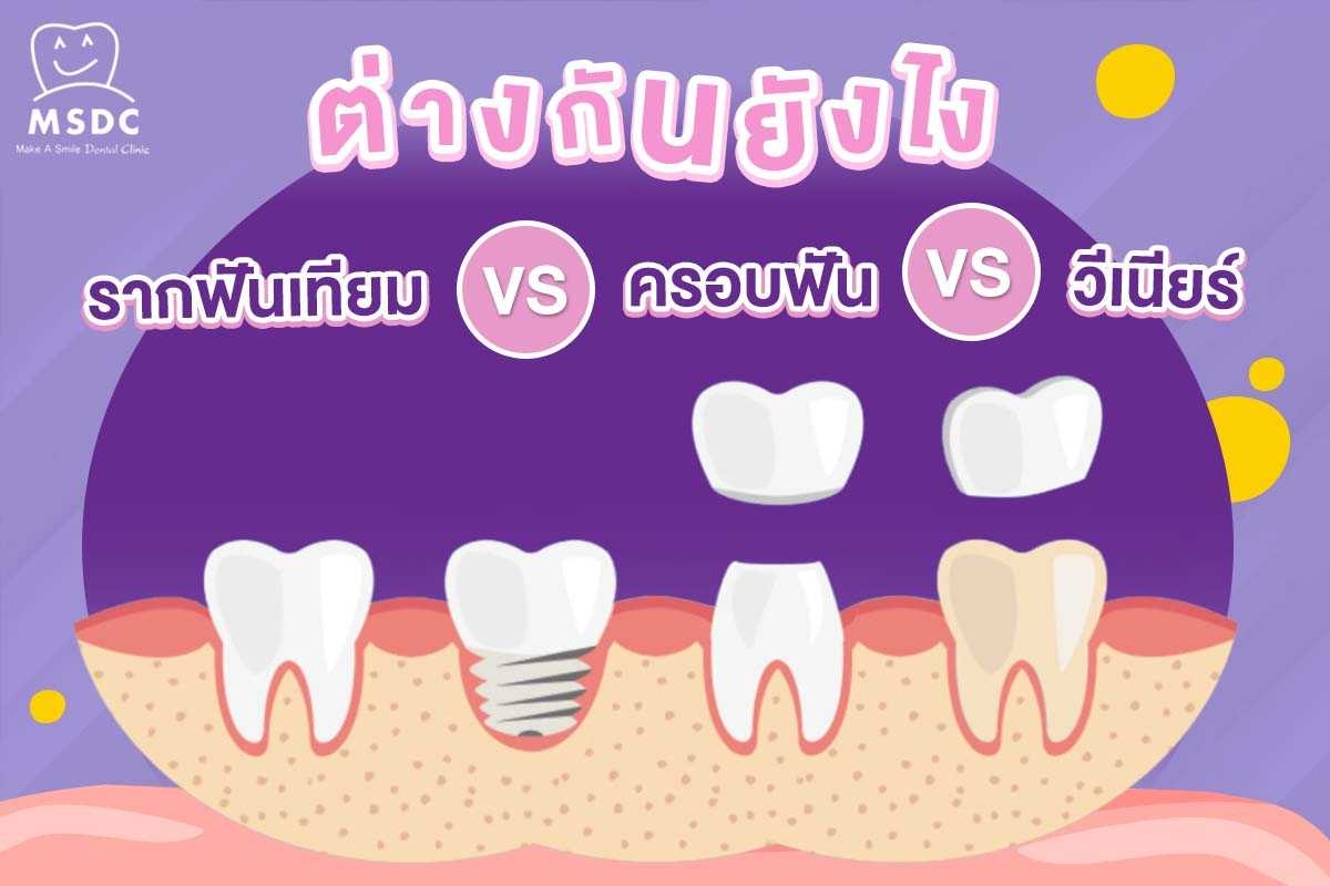 รากฟันเทียม VS ครอบฟัน VS วีเนียร์ ต่างกันยังไง !?