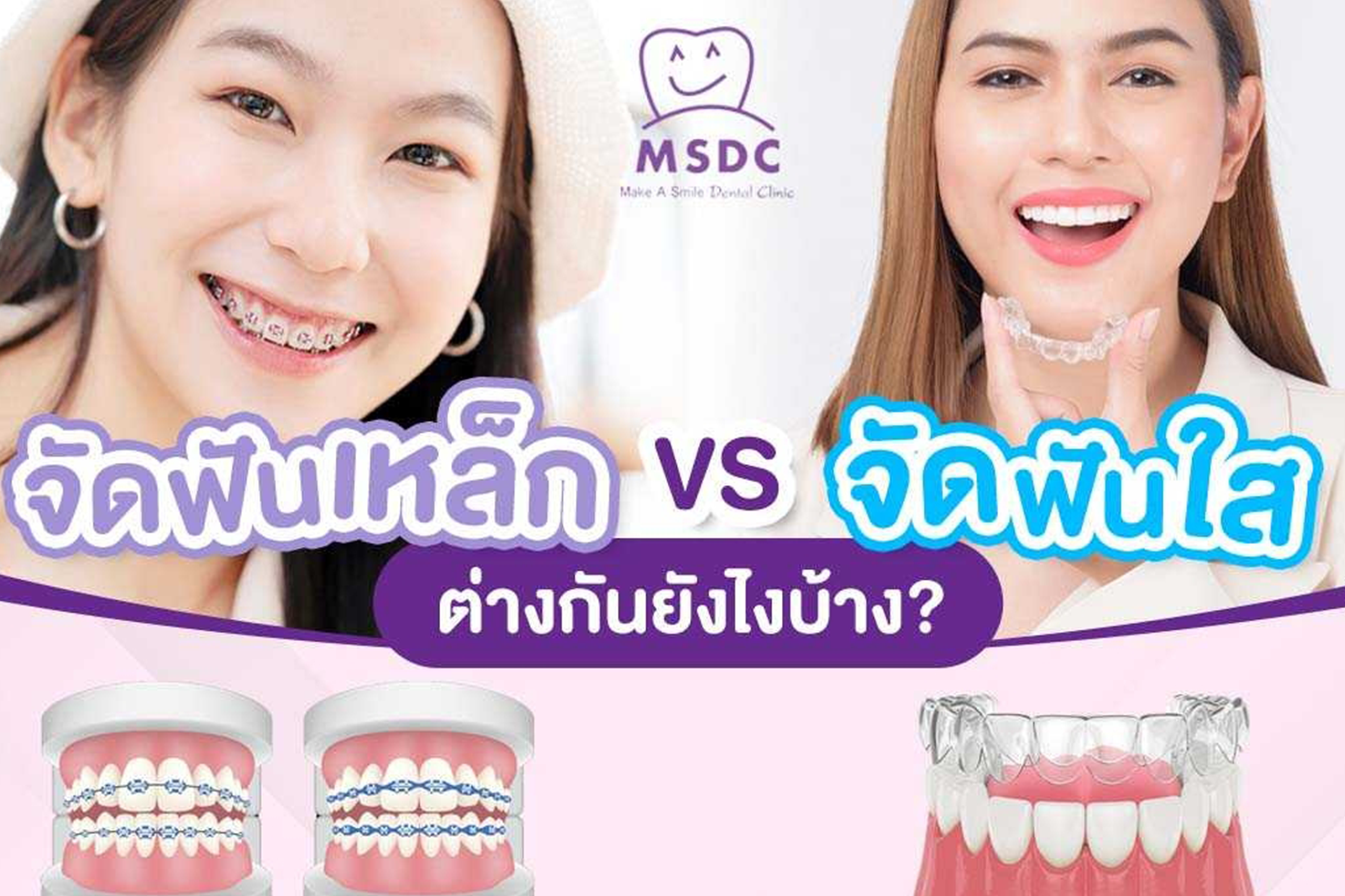 ไขข้อสงสัยเลือกจัดฟันใสดีไหมและต่างกับการจัดฟันเหล็ก !?