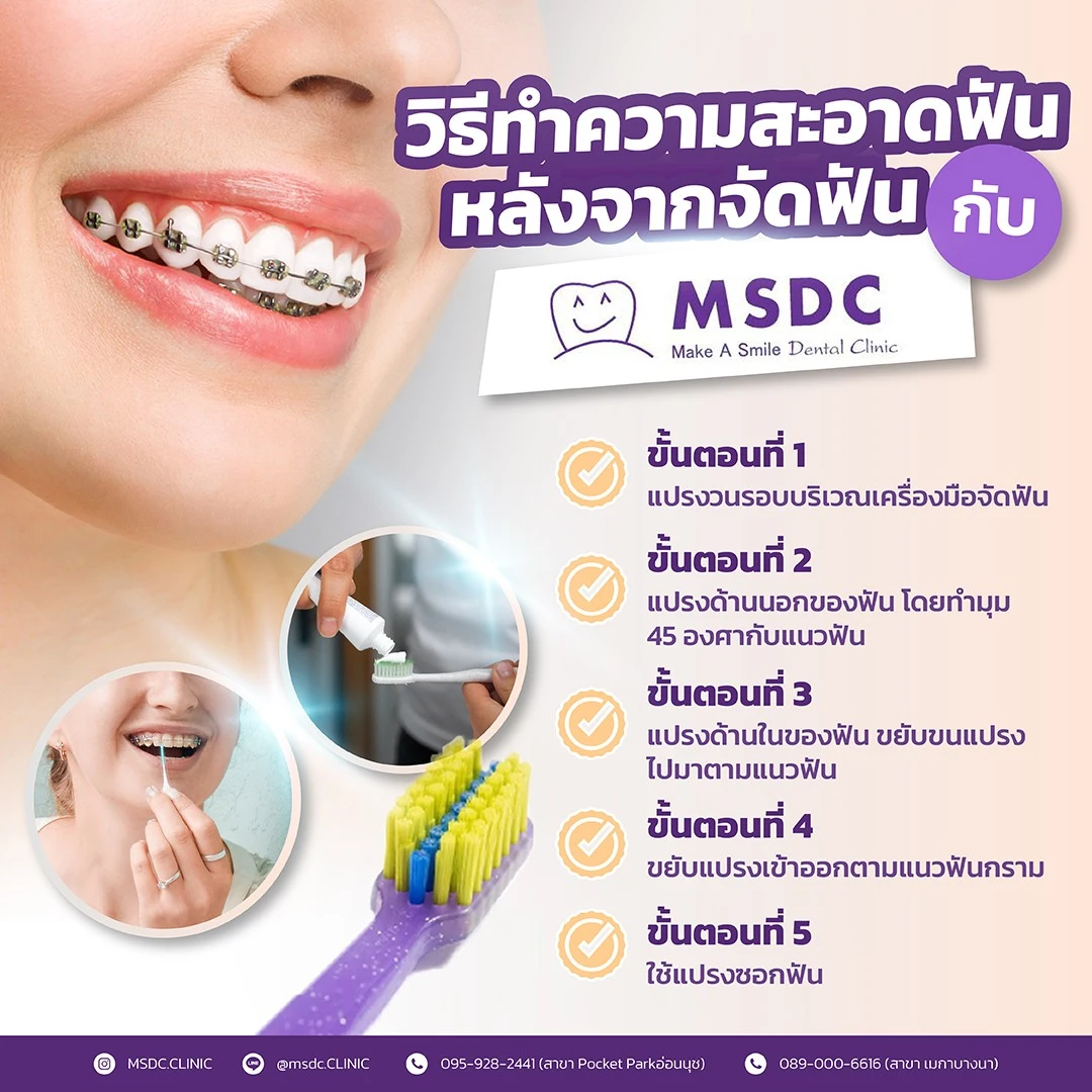 วิธีทำความสะอาดฟัน หลังจากจัดฟันกับ MSDC